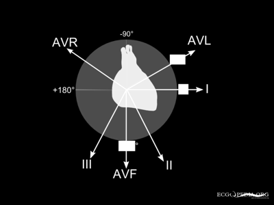 Snijpunt assen = AV-knoop Normale as van -30 tot +90 Horizontale as van -30 tot 0 De elektrische hartas - bepalen Snelle interpretape: