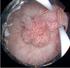 Urologie Het verwijderen van een tumor uit de blaas