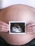 Als je nog zwanger bent na je uitgerekende datum (Serotiniteit) Poli Gynaecologie