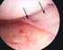 The effects of meniscal allograft transplantation on articular cartilage Rijk, P.C.