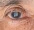 Richtlijnen bij een staaroperatie (cataract)